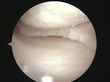this is the meniscus after the torn portion is resected.